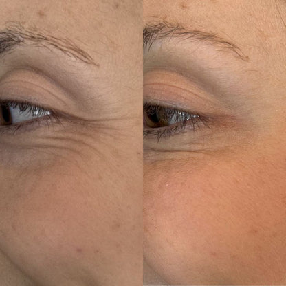Collagen Derma Roller